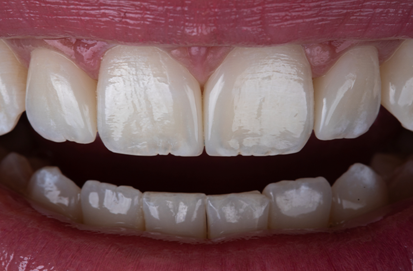 Elóra APS: una nueva forma de entender el color en odontología restauradora
