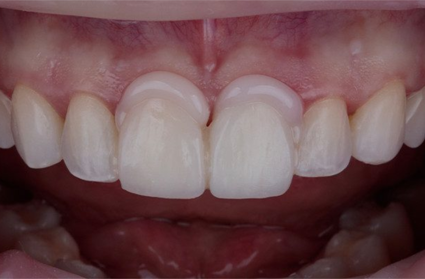 Sustitución de carillas de resina compuesta mediante blanqueamiento dental previo