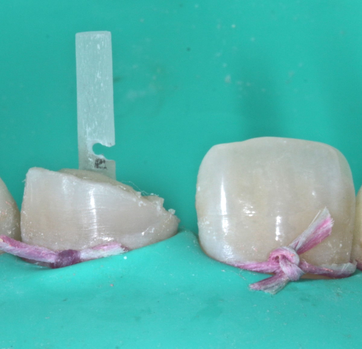 Colocación de poste Whitepost de 1mm de diametro previa confeccion de muesca a nivel coronal para recorte del excedente y posterior cementación. (Figura 12).